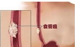 福州食道癌哪个医馆好