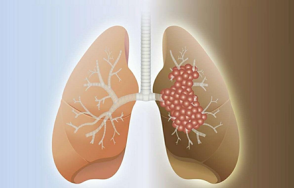 肺癌会有哪些常见症状