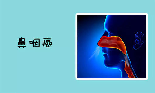 鼻咽癌的常见的症状
