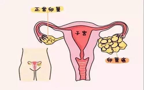 晚期卵巢癌的症状是什么