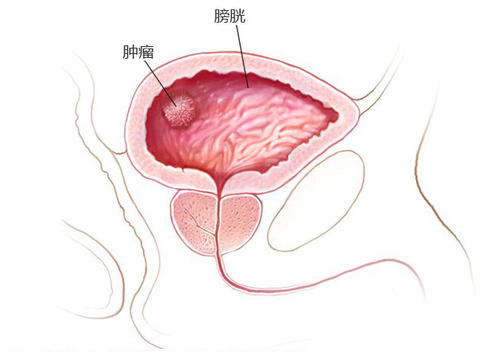 膀胱癌的病因是什么