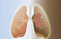 肺癌的发病原因有哪些？这些原因你知道吗？