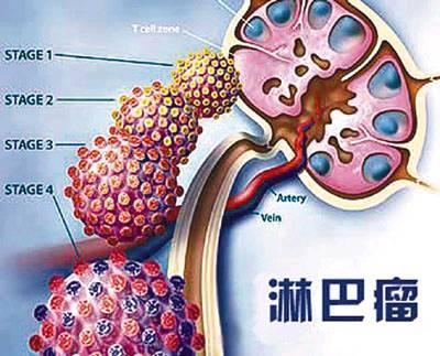 淋巴癌的致病原因有哪些?这些原因你需要知道!